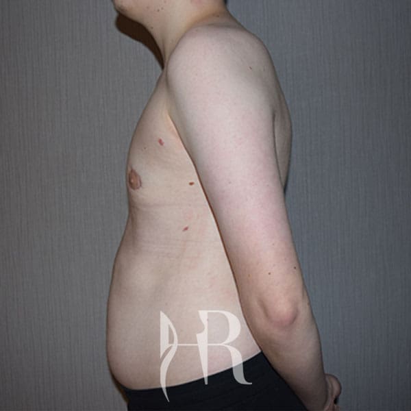 HR Plastic Surgery - Male Breast Reduction patient after 3